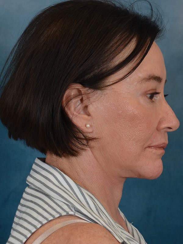Brow Lift Before & After Gallery - Patient 412841 - Image 8