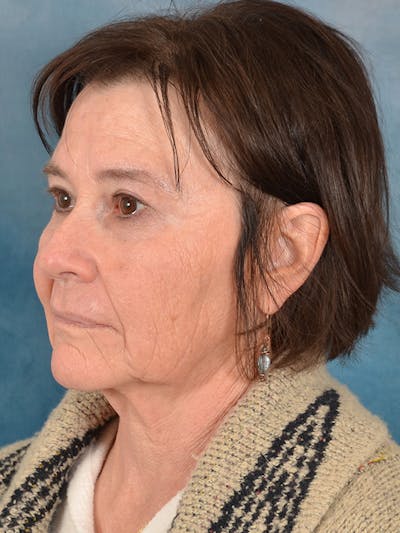 Earlobe Repair Before & After Gallery - Patient 708603 - Image 1