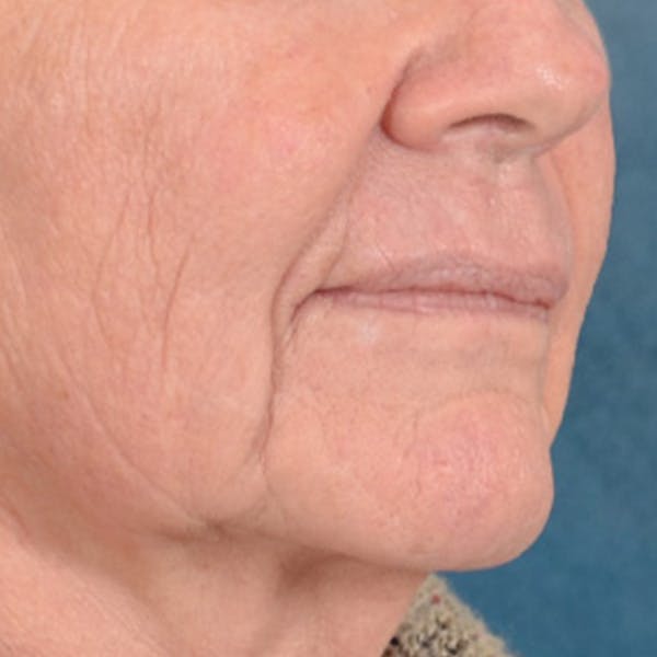 Lip Lift Before & After Gallery - Patient 106589 - Image 3