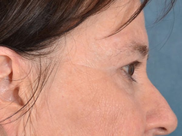 Eyelid Lift Before & After Gallery - Patient 586331 - Image 5