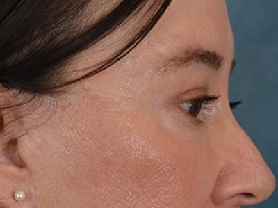 Eyelid Lift Before & After Gallery - Patient 586331 - Image 6