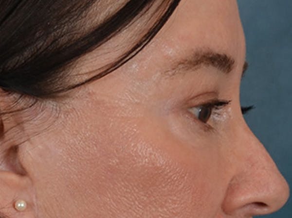 Eyelid Lift Before & After Gallery - Patient 586331 - Image 6