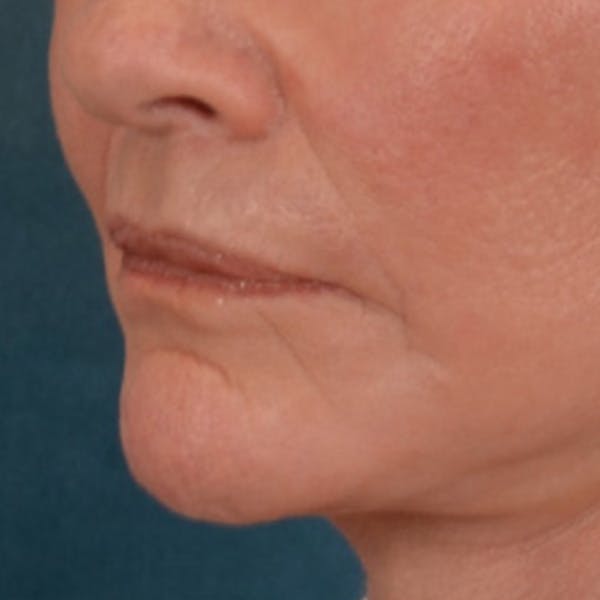 Lip Lift Before & After Gallery - Patient 106589 - Image 6