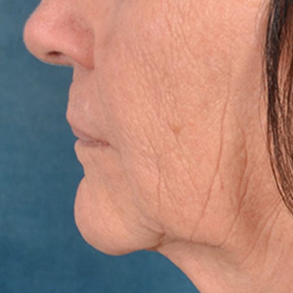 Lip Lift Before & After Gallery - Patient 106589 - Image 9