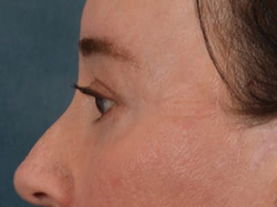 Eyelid Lift Before & After Gallery - Patient 586331 - Image 10