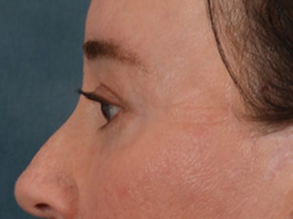 Eyelid Lift Before & After Gallery - Patient 586331 - Image 10