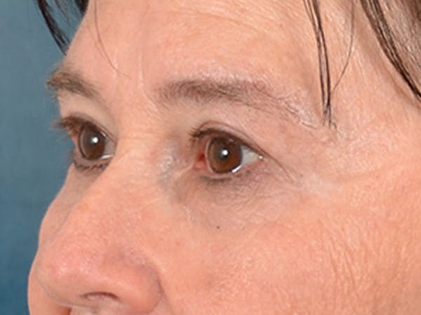 Eyelid Lift Before & After Gallery - Patient 586331 - Image 7