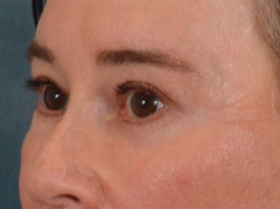 Eyelid Lift Before & After Gallery - Patient 586331 - Image 8