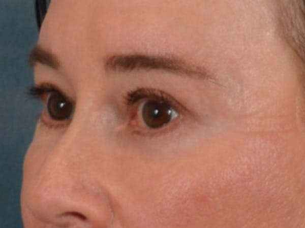 Eyelid Lift Before & After Gallery - Patient 586331 - Image 8
