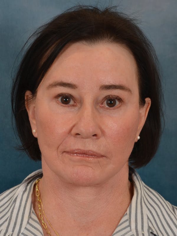 Brow Lift Before & After Gallery - Patient 412841 - Image 4