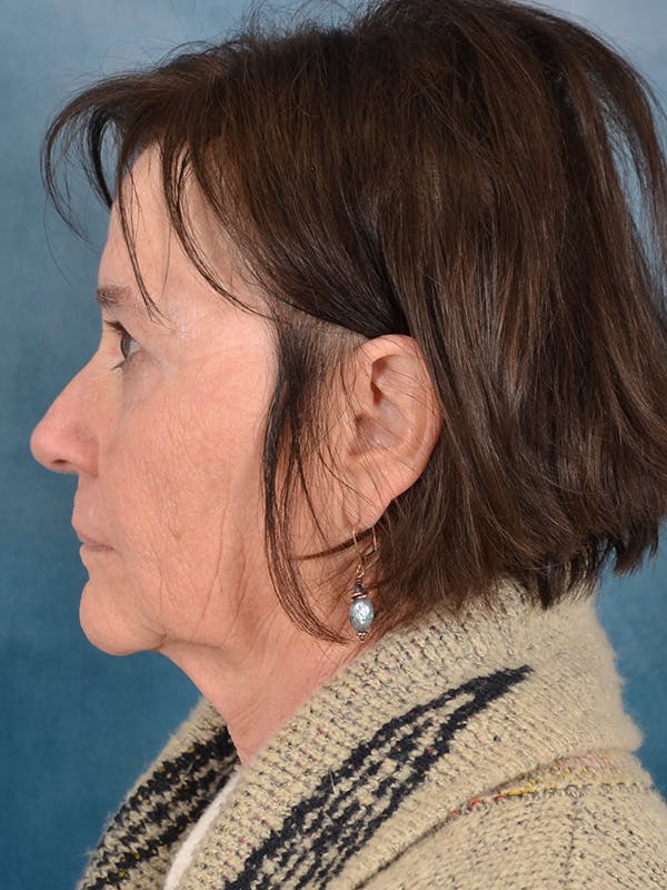 Brow Lift Before & After Gallery - Patient 412841 - Image 9