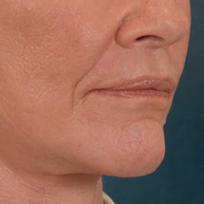 Lip Lift Before & After Gallery - Patient 106589 - Image 4
