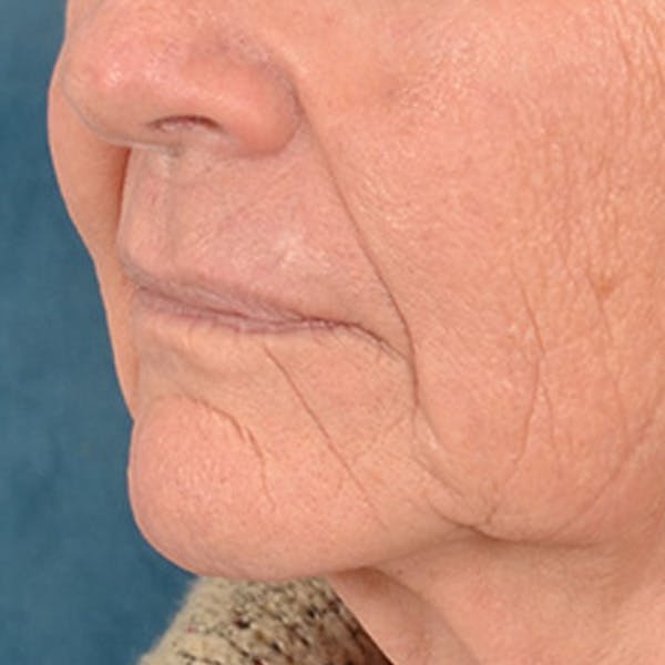 Lip Lift Before & After Gallery - Patient 106589 - Image 5