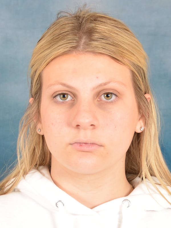 Rhinoplasty Before & After Gallery - Patient 292875 - Image 5