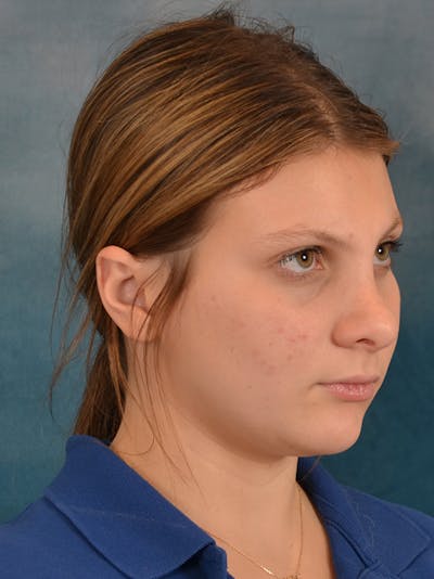 Rhinoplasty Before & After Gallery - Patient 292875 - Image 8