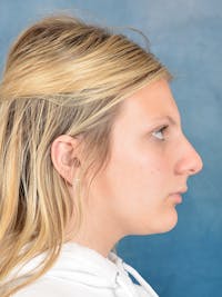 Rhinoplasty Before & After Gallery - Patient 292875 - Image 1