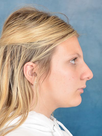 Rhinoplasty Before & After Gallery - Patient 292875 - Image 1