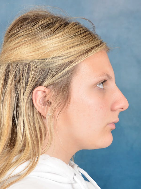 Rhinoplasty Before & After Gallery - Patient 292875 - Image 1