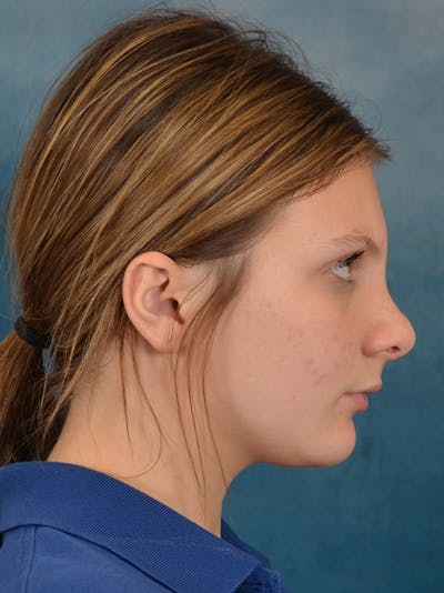 Rhinoplasty Before & After Gallery - Patient 292875 - Image 2