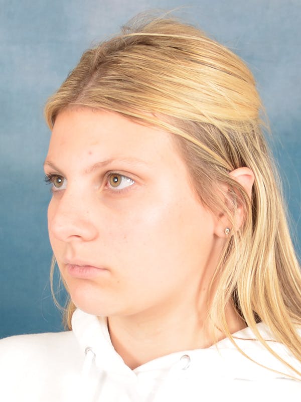 Rhinoplasty Before & After Gallery - Patient 292875 - Image 3