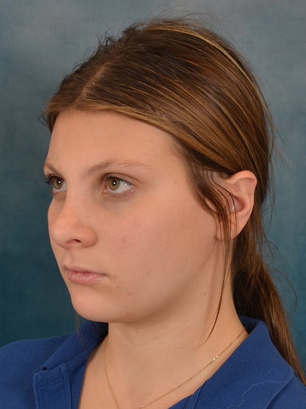 Rhinoplasty Before & After Gallery - Patient 292875 - Image 4