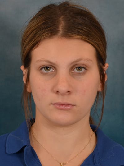 Rhinoplasty Before & After Gallery - Patient 292875 - Image 6