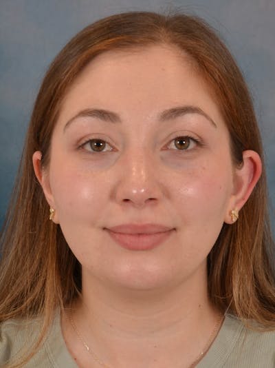 Rhinoplasty Before & After Gallery - Patient 251299 - Image 6