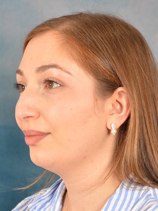 Rhinoplasty Before & After Gallery - Patient 251299 - Image 3