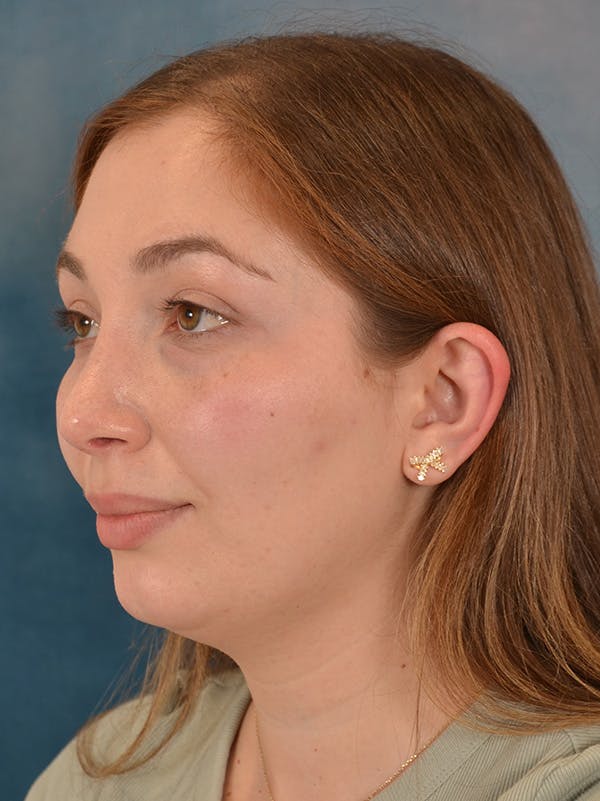 Rhinoplasty Before & After Gallery - Patient 251299 - Image 4