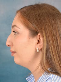 Rhinoplasty Before & After Gallery - Patient 251299 - Image 1