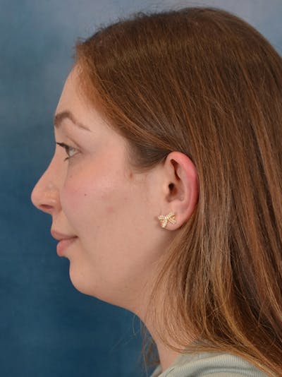 Rhinoplasty Before & After Gallery - Patient 251299 - Image 2