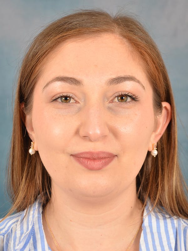 Rhinoplasty Before & After Gallery - Patient 251299 - Image 5