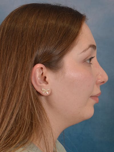 Rhinoplasty Before & After Gallery - Patient 251299 - Image 10