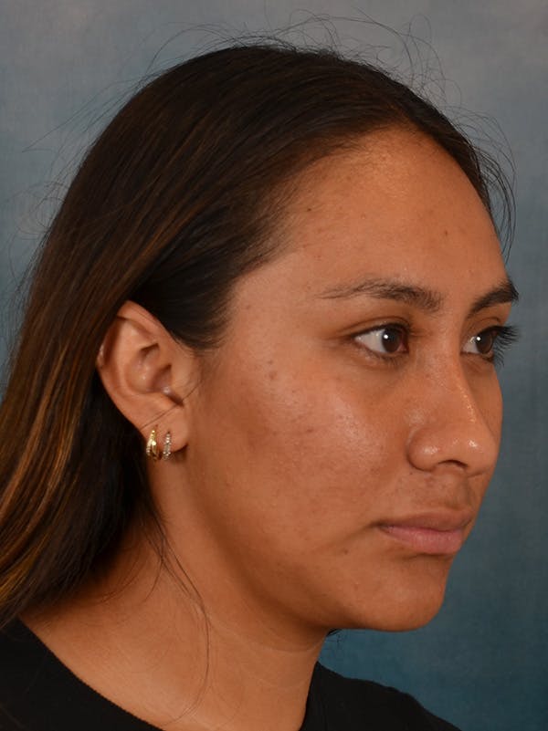 Rhinoplasty Before & After Gallery - Patient 174036 - Image 8