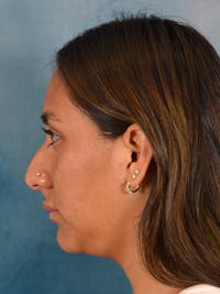 Rhinoplasty Before & After Gallery - Patient 174036 - Image 1