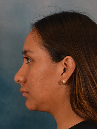Rhinoplasty Before & After Gallery - Patient 174036 - Image 2