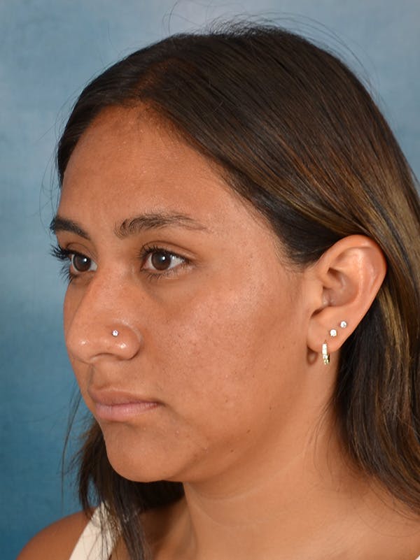Rhinoplasty Before & After Gallery - Patient 174036 - Image 3