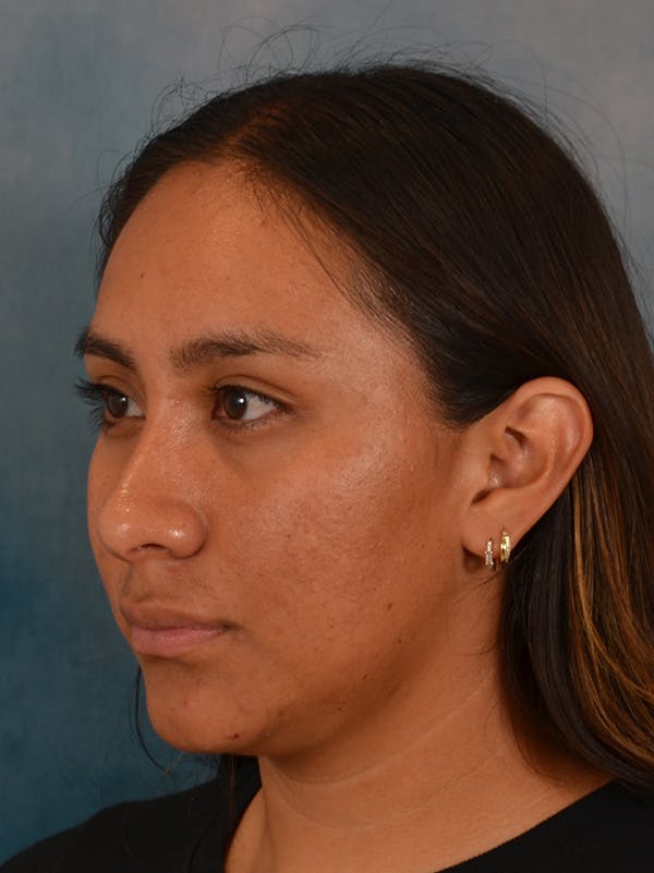 Rhinoplasty Before & After Gallery - Patient 174036 - Image 4