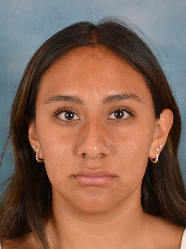 Rhinoplasty Before & After Gallery - Patient 174036 - Image 5