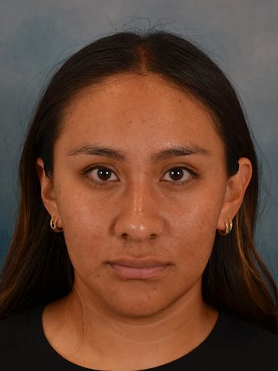 Rhinoplasty Before & After Gallery - Patient 174036 - Image 6