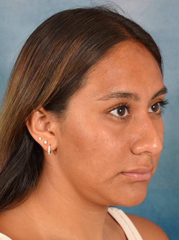 Rhinoplasty Before & After Gallery - Patient 174036 - Image 7