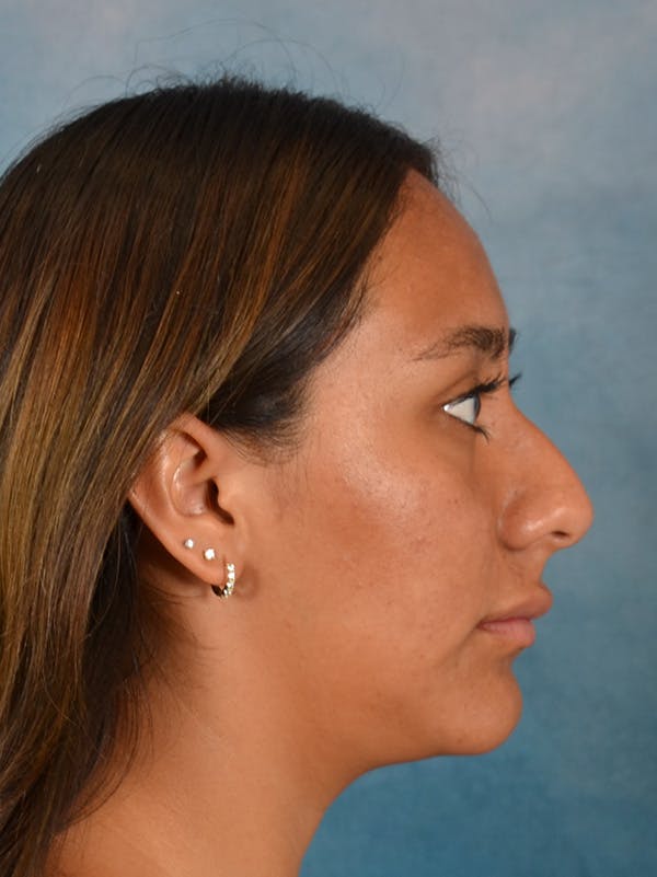 Rhinoplasty Before & After Gallery - Patient 174036 - Image 9