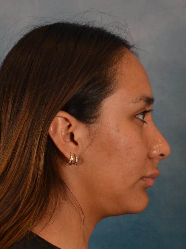 Rhinoplasty Before & After Gallery - Patient 174036 - Image 10