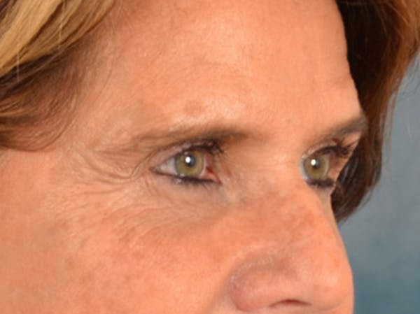Eyelid Lift Before & After Gallery - Patient 635760 - Image 3