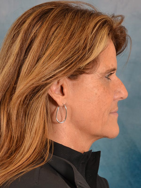 Laser Skin Resurfacing Before & After Gallery - Patient 151667 - Image 5