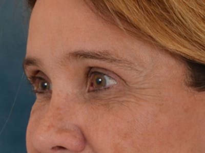 Eyelid Lift Before & After Gallery - Patient 635760 - Image 8