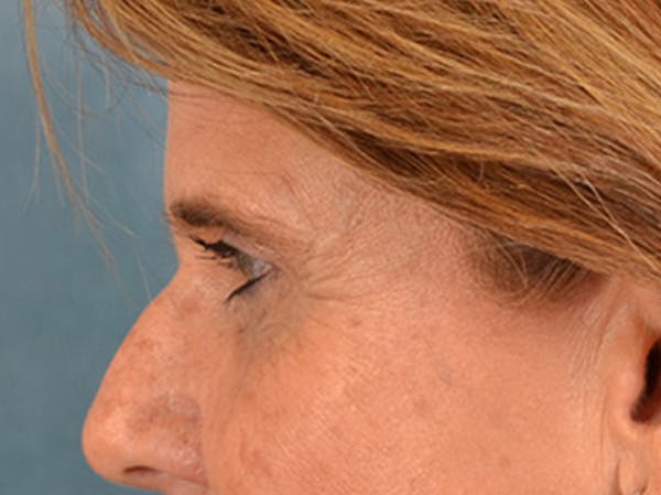 Eyelid Lift Before & After Gallery - Patient 635760 - Image 9