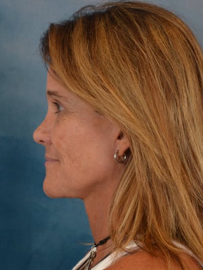 Rhinoplasty Before & After Gallery - Patient 165317 - Image 2