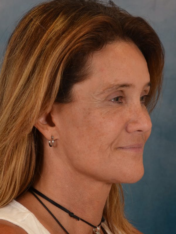 Eyelid Lift Before & After Gallery - Patient 635760 - Image 4