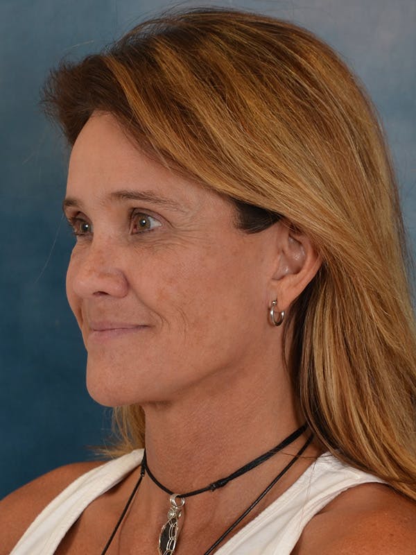 Laser Skin Resurfacing Before & After Gallery - Patient 151667 - Image 8